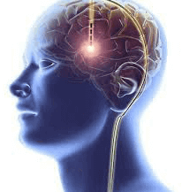 Stimularea cerebrala profunda SCP DBS